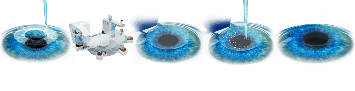 FEMTOLASIK VISUMAX® ZEISS